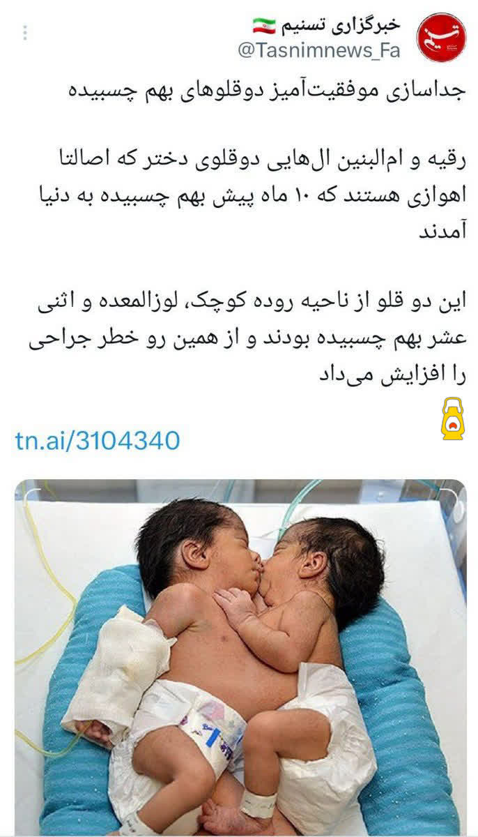 انجام عمل موفق آمیز جداسازی دوقلوهای بهم چسبیدهی با توان پزشکان، متخصصان و جراحان کشورمان??✌️