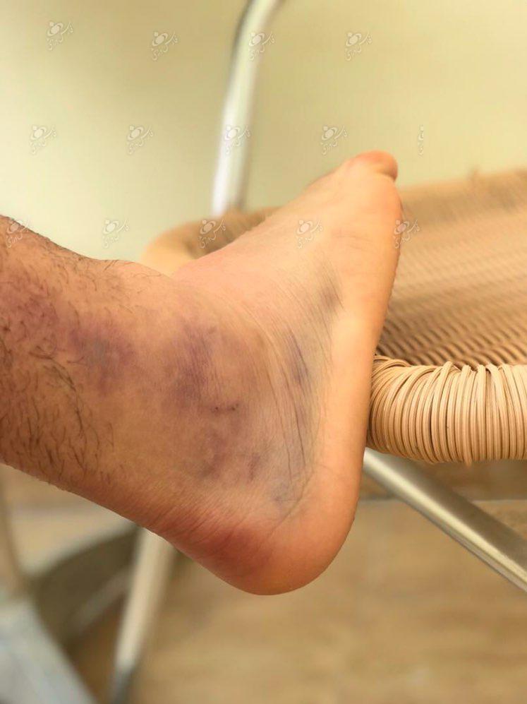مچ پای امید عالیشاه