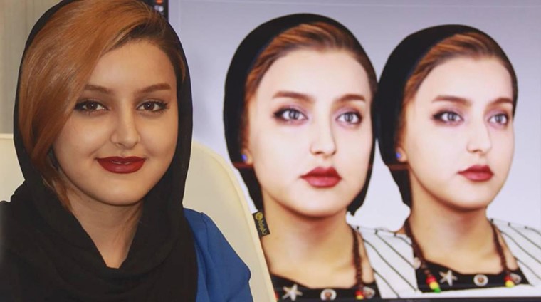 آگهی؛ بینی گوشتی به چه میزان با جراحی تغییر میکند؟